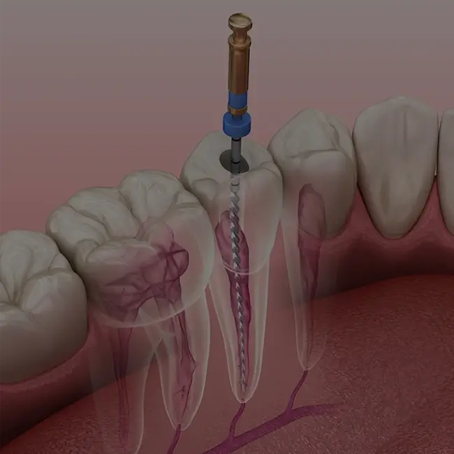 Root Canal services: Dental root canal treatment.