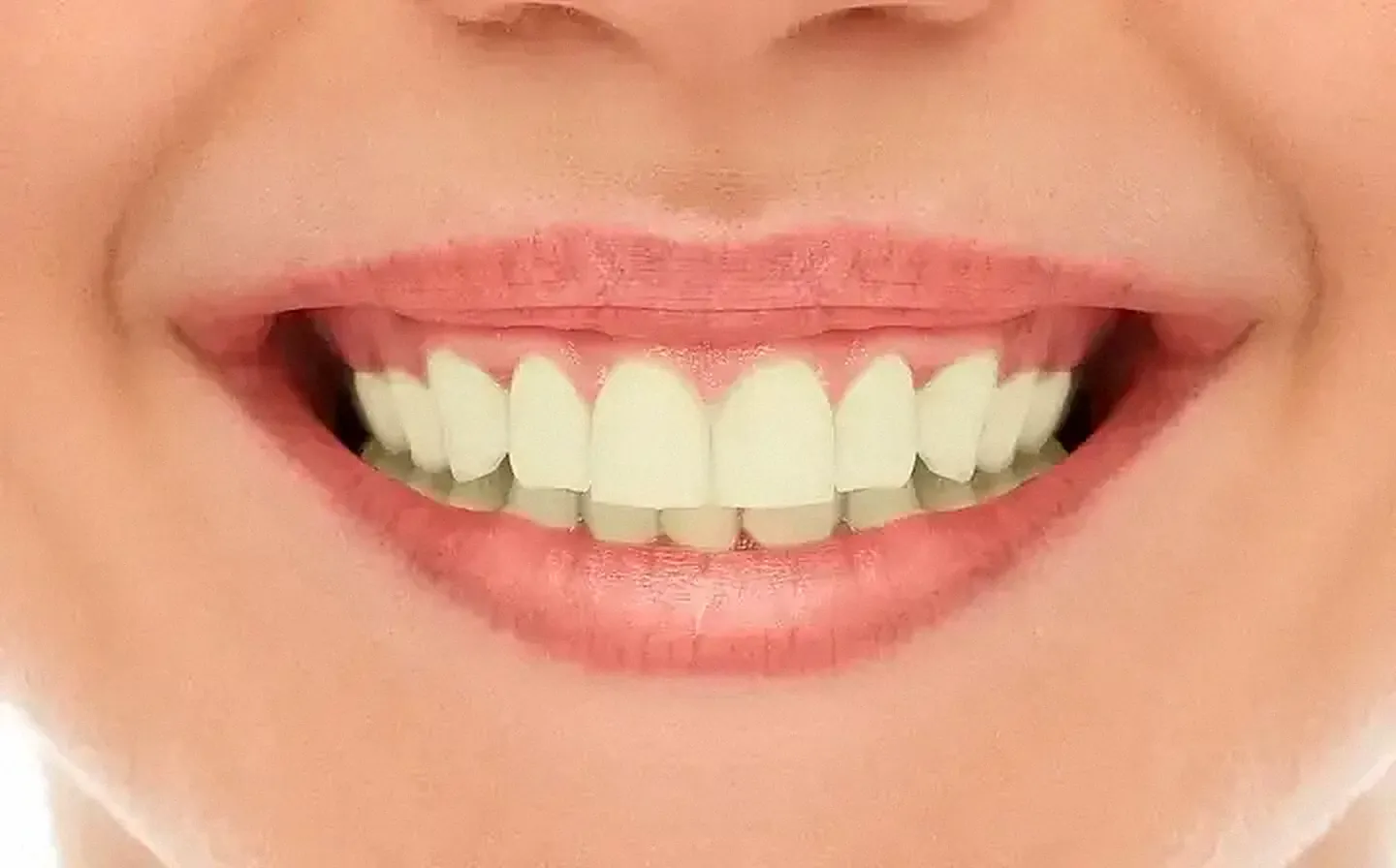 Smile before whitening
